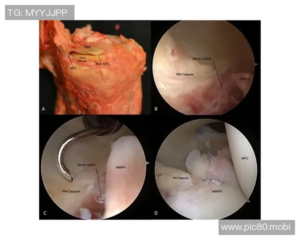 医学教授：萨博尼斯接受的半月板修复手术恢复周期为4-6个月